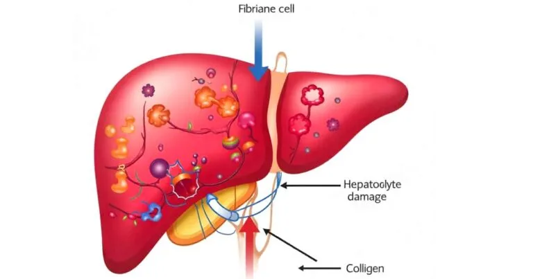 Illustration showing progression of liver fibrosis with scar tissue formation